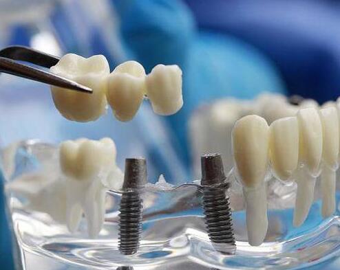4月20日起北京种植牙费用将大幅降低
